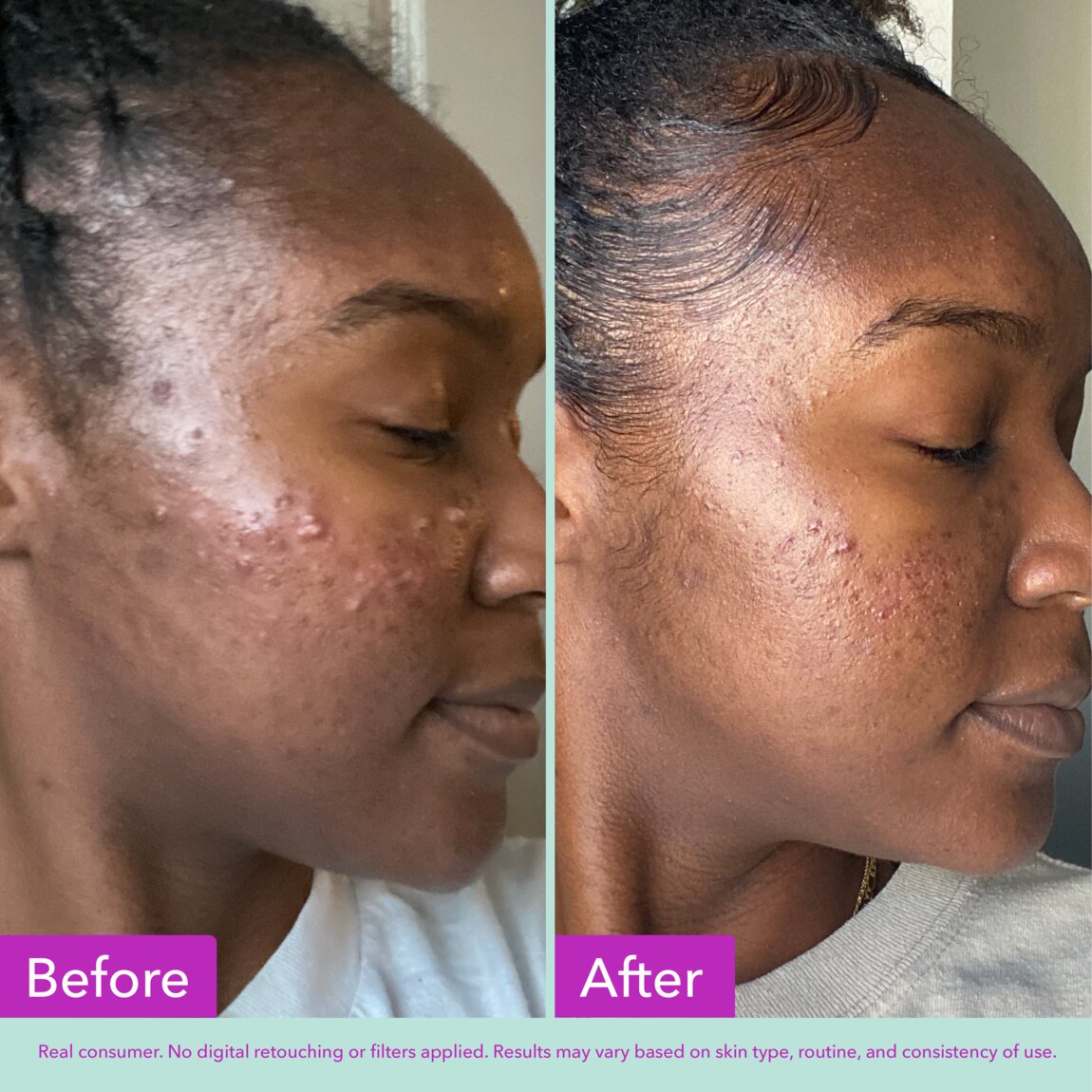 acne-foaming-cleanser-c2 zb_p.jpg